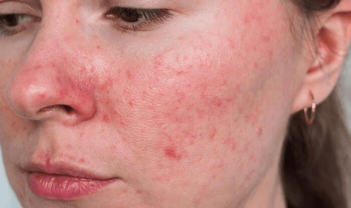 rosacea-symptomer-og-behandling-sundhedsartikler-dk